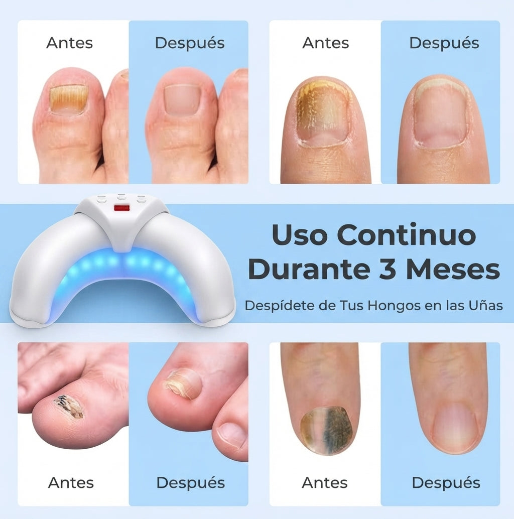 Dispositivo de Fototerapia para el Cuidado de las Uñas